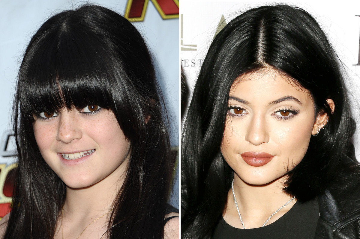 kylie-jenner-before-and-afterjpg.jpg