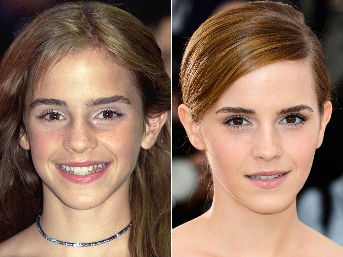 Emma Watson, Before and After - Beautyeditor Emma Watson Before And After.